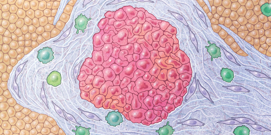 From Salk Institute discovery to patient care: Vitamin D analog shuts down pancreatic cancer’s shield in clinical trial