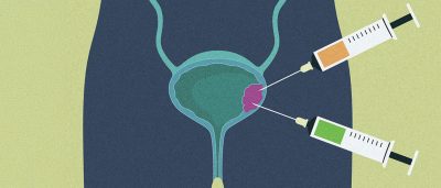 putting-a-lid-on-excess-cholesterol-to-halt-bladder-cancer-cell-growth