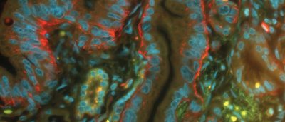 astrocyte-protein-linked-to-healthy-brain-connections-could-inspire-new-treatments-for-alzheimers